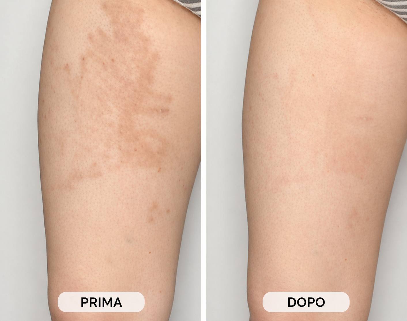 Dischetti viso acido kojico & curcuma